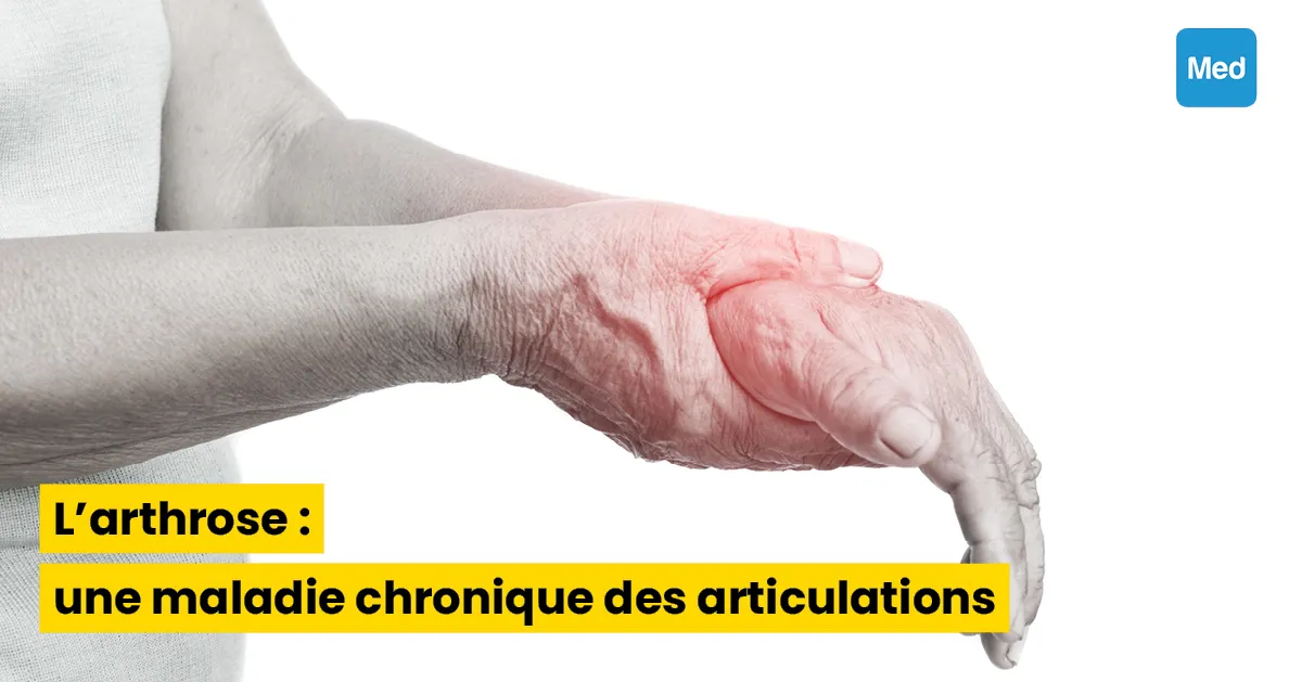 L'arthrose : une maladie chronique des articulations